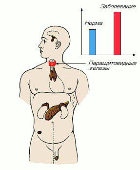 >Уровень гормона при гиперпаратиреозе
